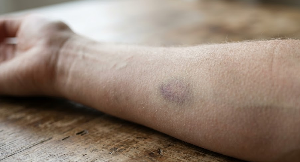 Close-up of a subtle purplish bruise on a person's forearm, indicating potential issues with biological coagulation pathways.